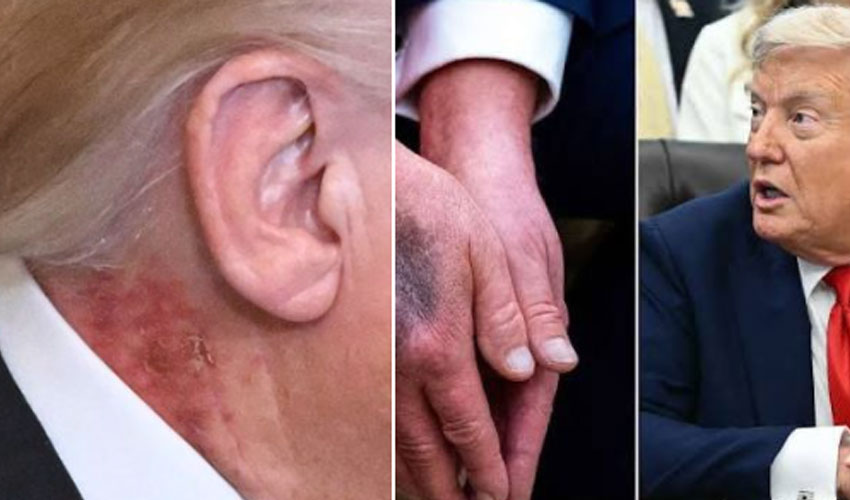 Is Trump’s health at risk? Neck rash sparks public speculation
