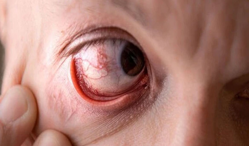 Study links wegovy weight loss drug to vision loss risk