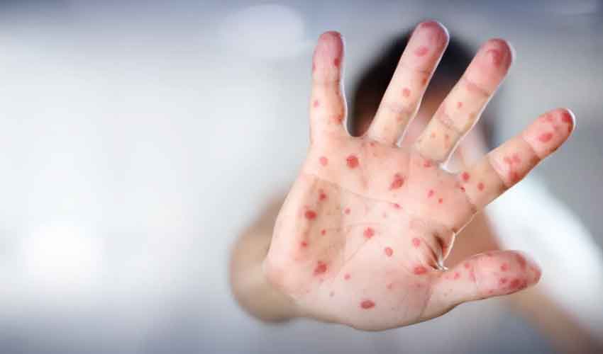 Seven children die in Kabirwala, measles fears spark probe