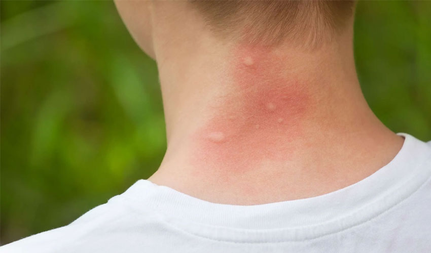 Prevent skin diseases in summer – Easy tips